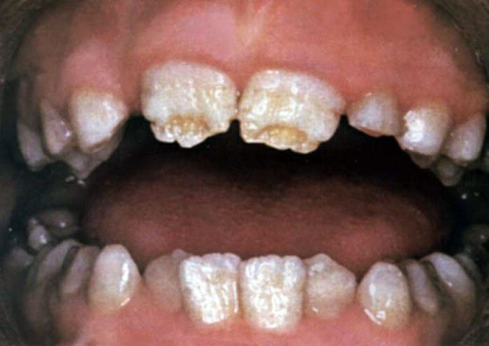 Гипоплазия зубной эмали у детей