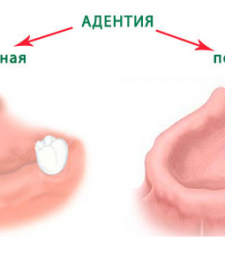 Как выглядит адентия зубов?