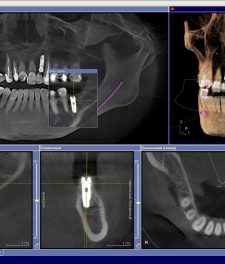 Компьютерная 3D томография зубов