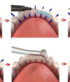 Проведение процедуры шинирования в стоматологии