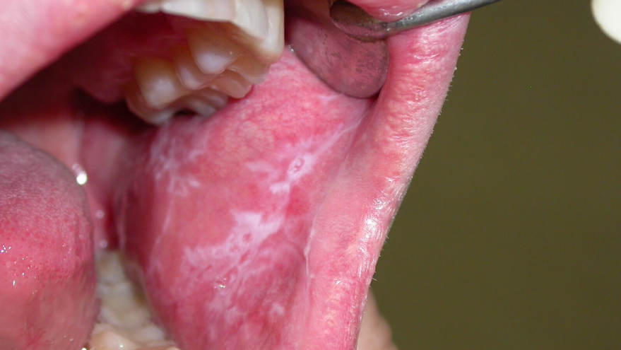 Как выглядит лейкоплакия рта?