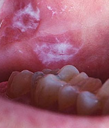 Лейкоплакия полости рта - фото