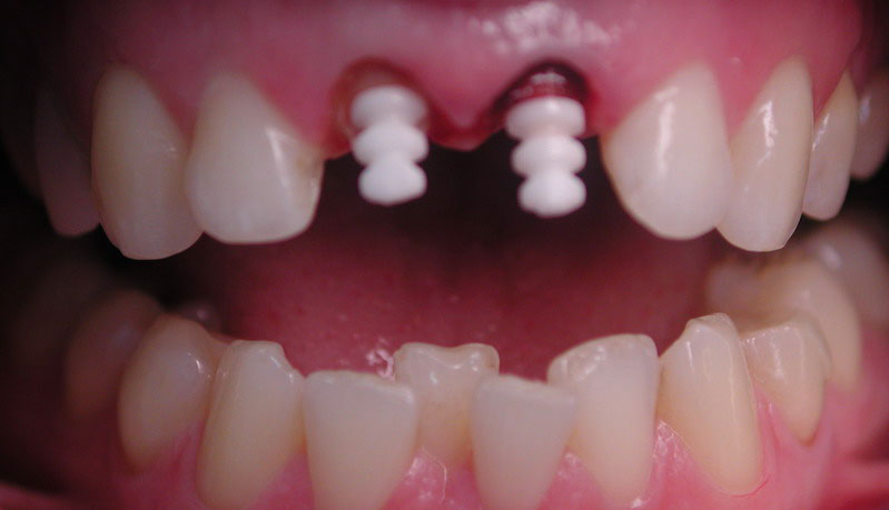Зубной штифт - фото
