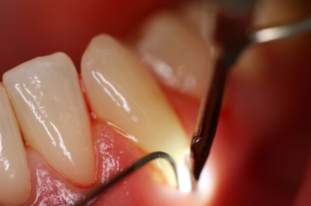Как выглядит клиновидный дефект зубов?