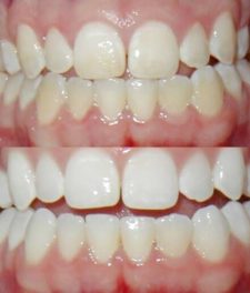 Эффект отбеливания зубов с помощью соды