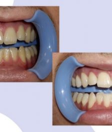 Отбеливание зубов Beyond Polus