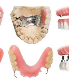 Зубное протезирование и его виды
