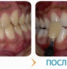 Отбеливание зубов Klox: фото до и после