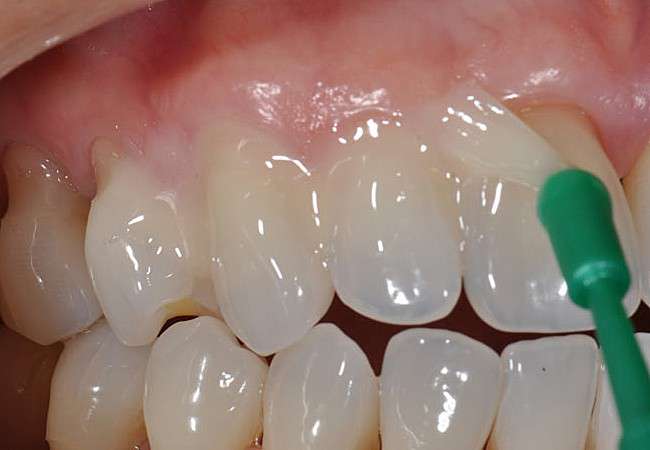 Имплантация зубной эмали - фото