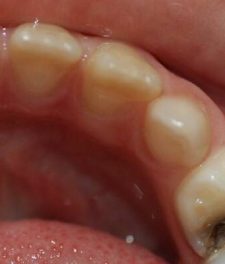 Как выглядит пульпит молочного зуба?