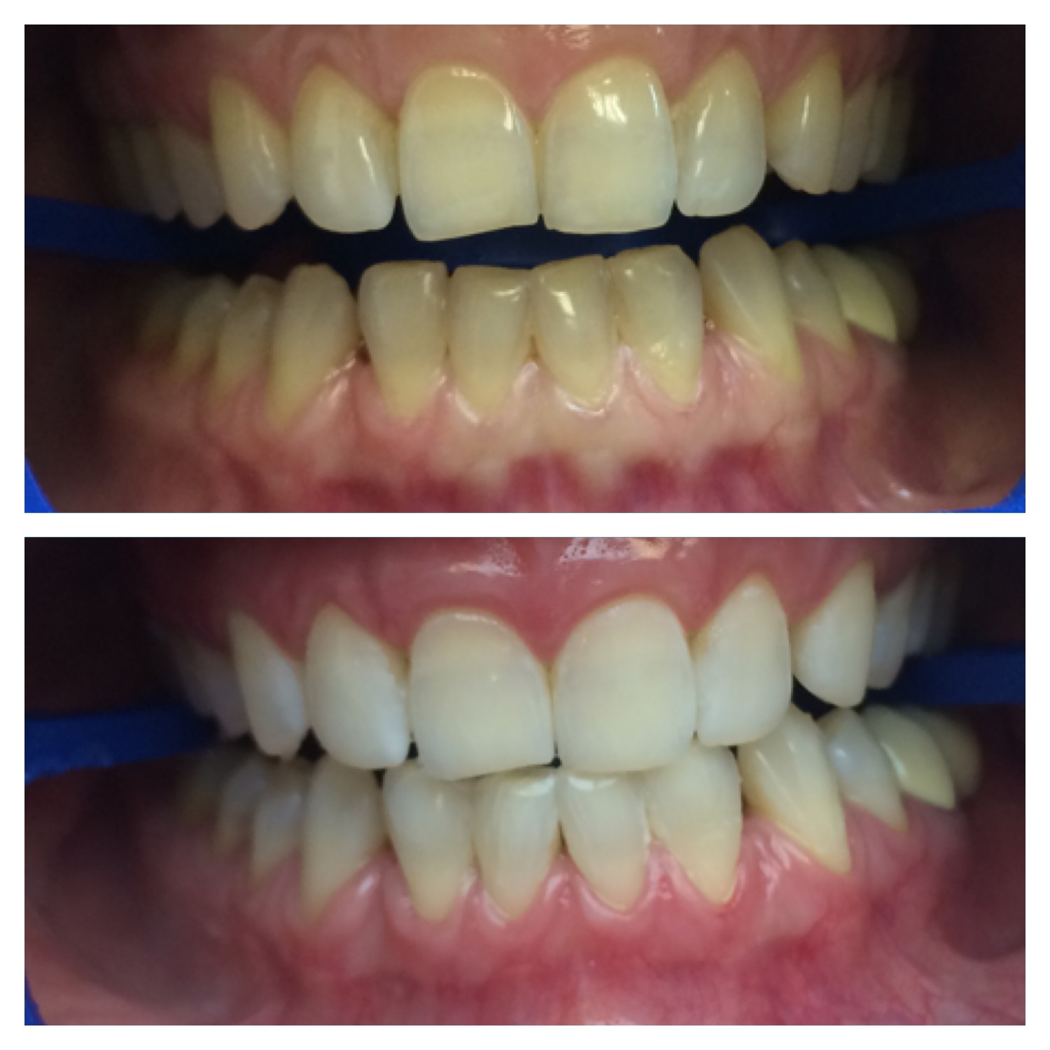 Холодное отбеливание зубов: фото до и после