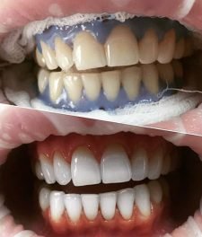 Отбеливание зубов Amazing White: фото до и после