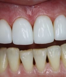 Реставрация зубов - разница