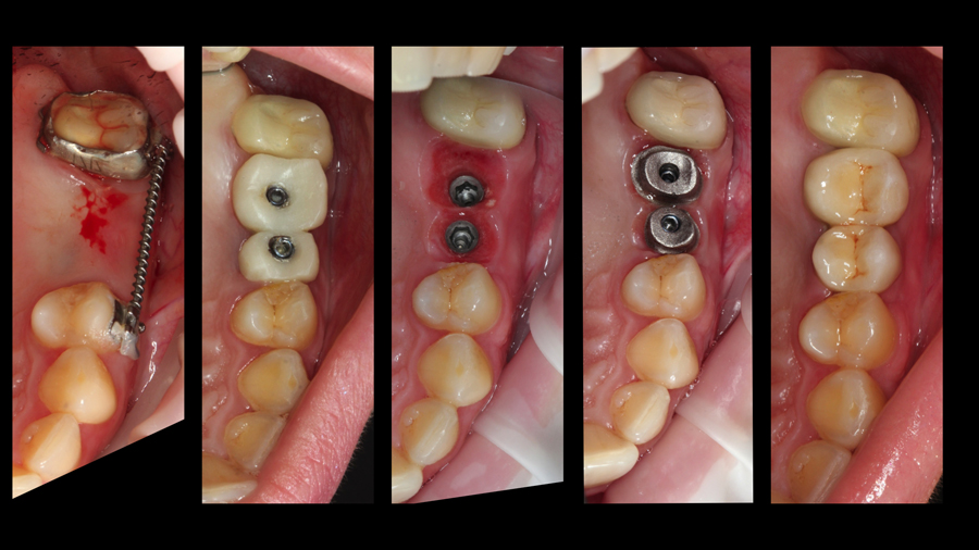 Импланты на жевательные зубы