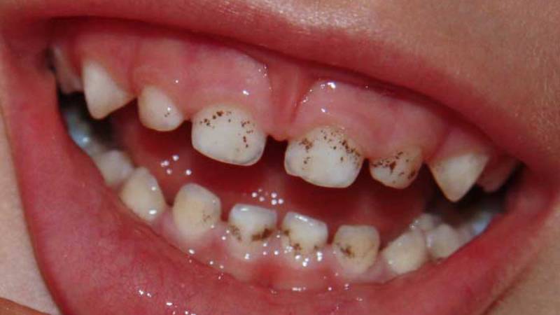 Черные точки на зубах у ребенка