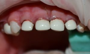 Детские коронки на молочные зубы