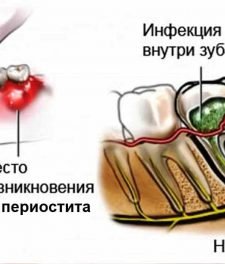 Схема воспаления надкостницы в стоматологии