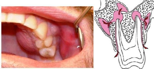 Болит надкостница после удаления зуба