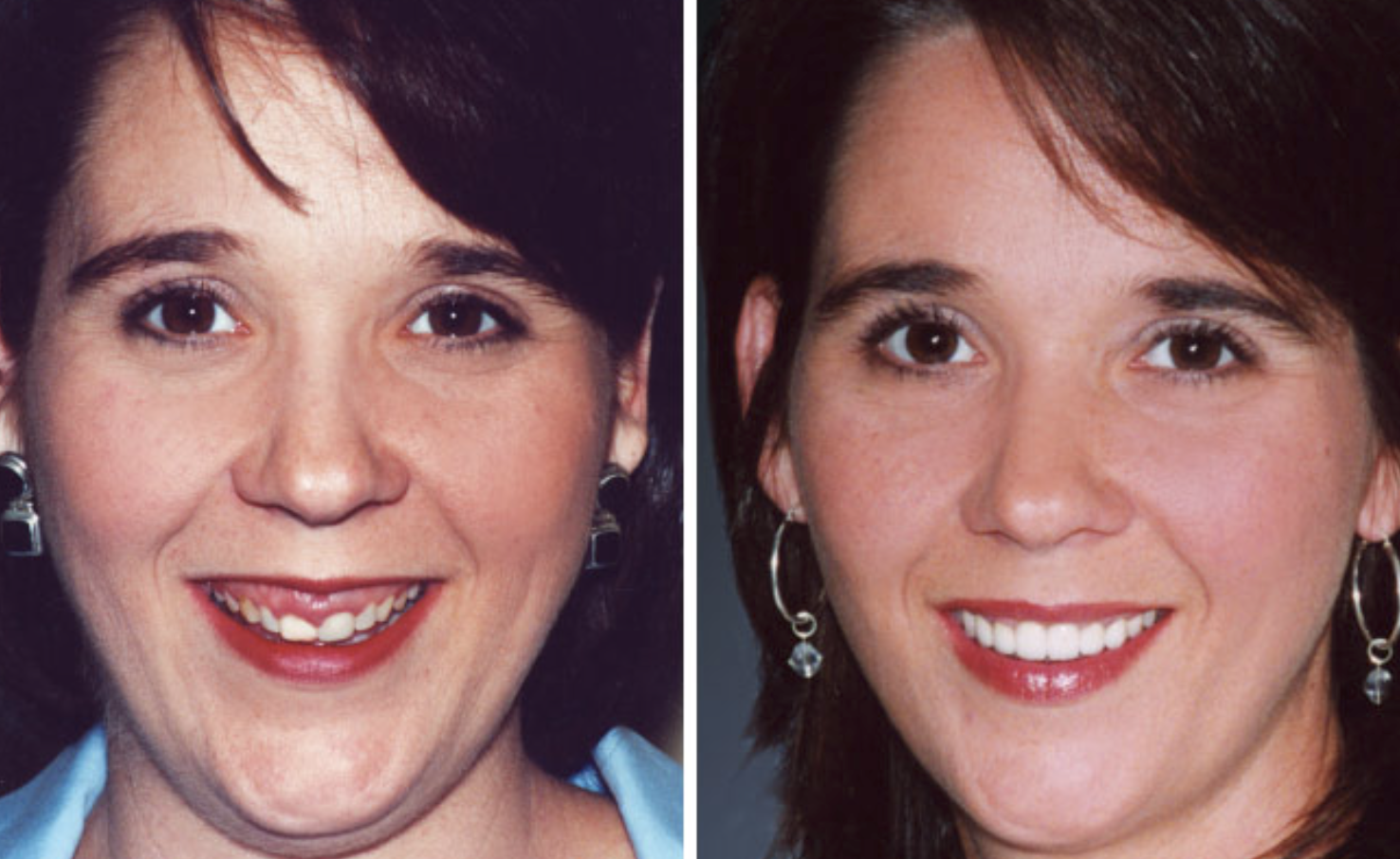 Десневая улыбка - фото до и после