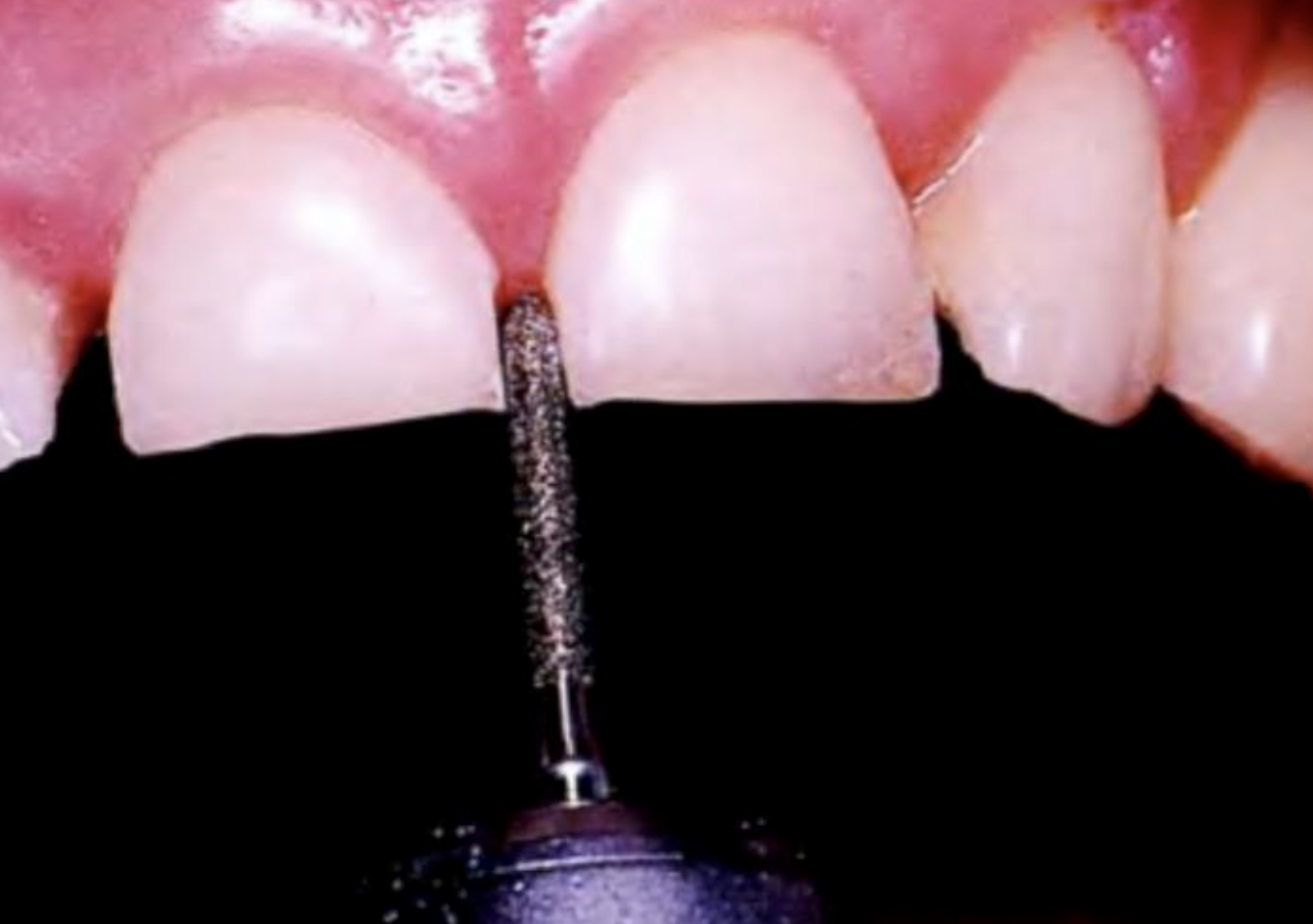 Сепарация зубов