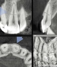 Перелом корня зуба