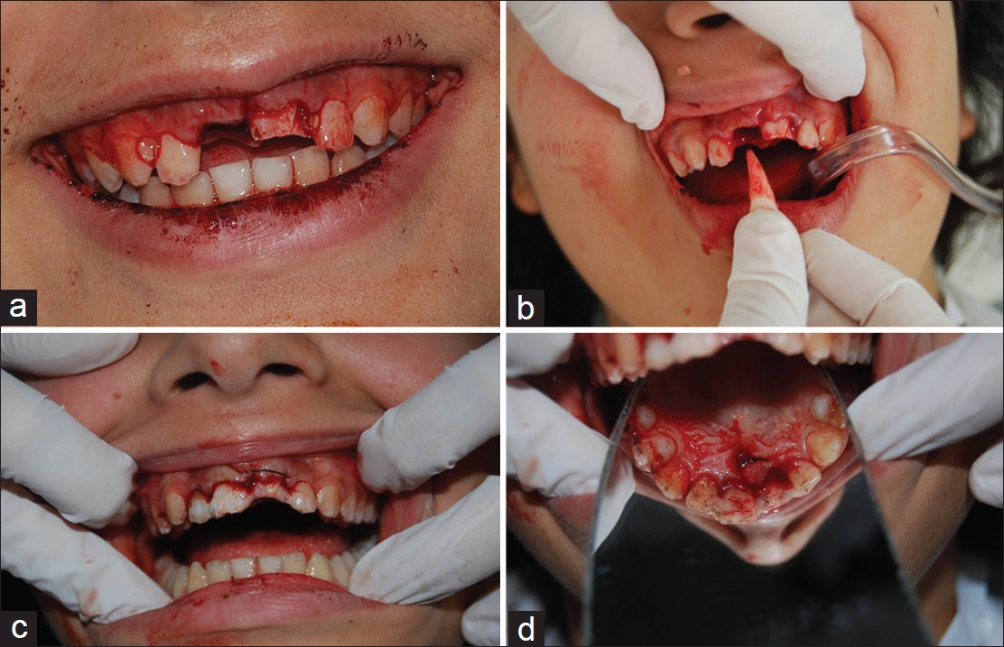 Выполнение операции по реплантации зуба