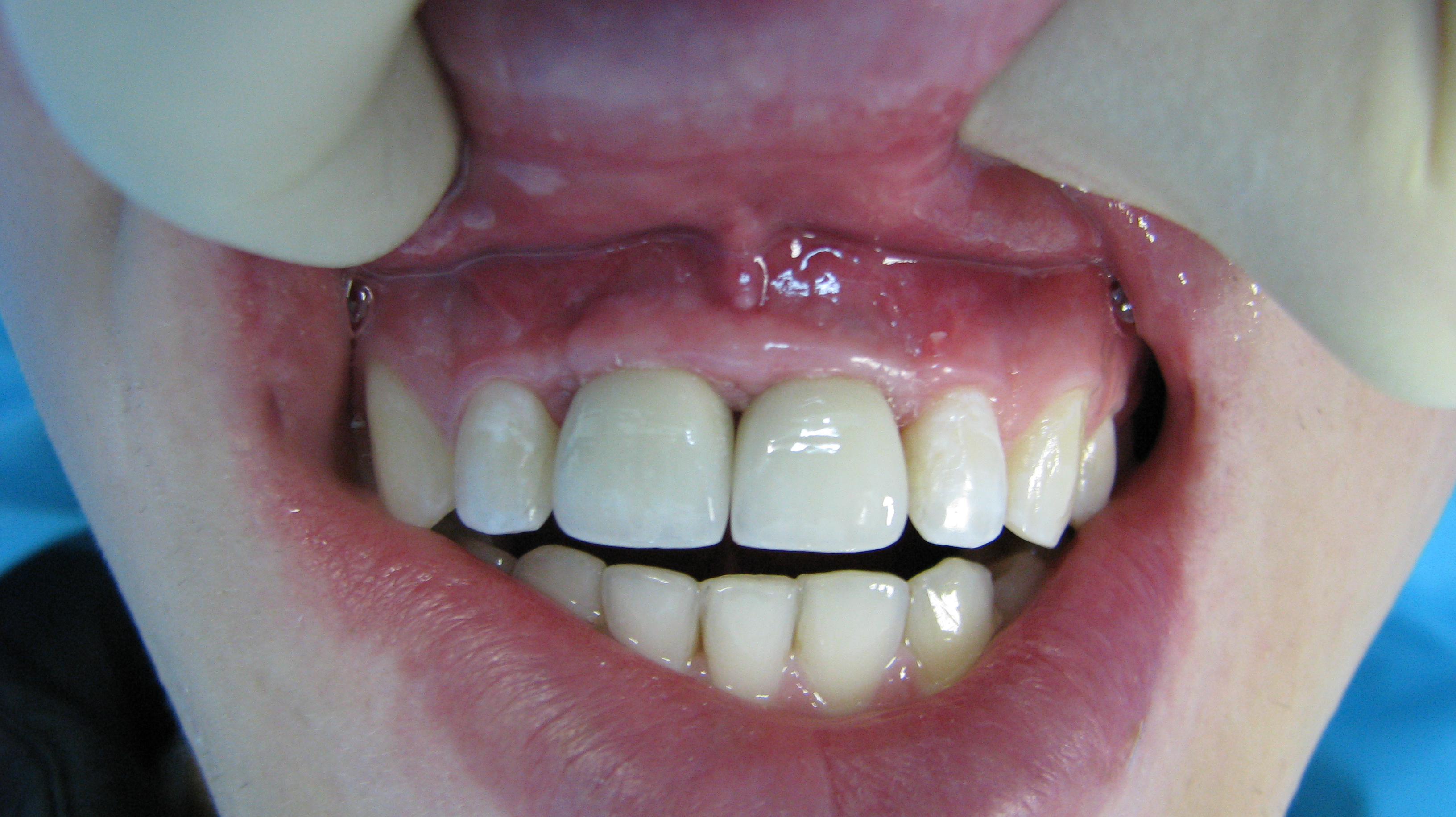 Импланты на передние зубы, фото после