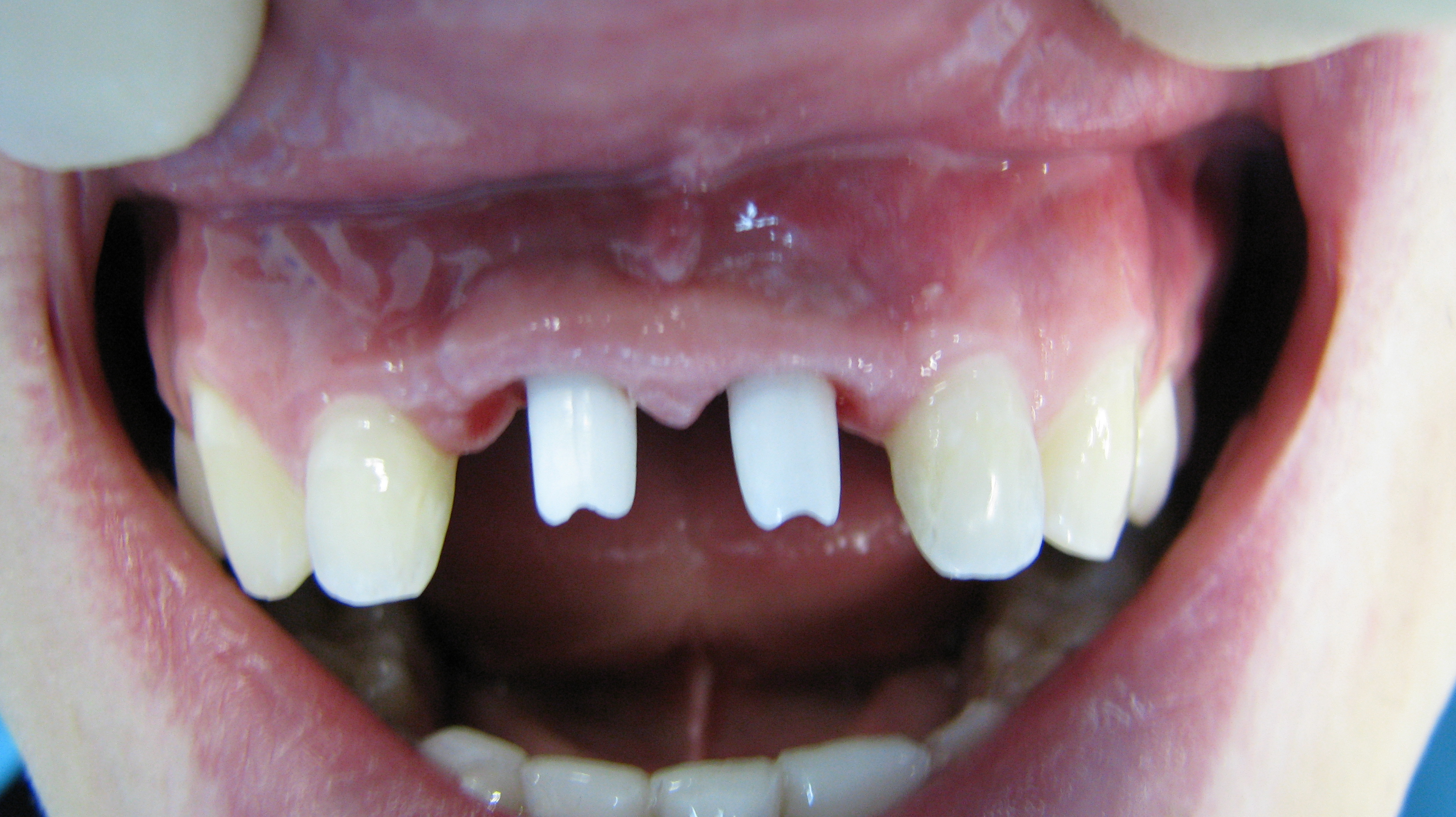 Имплантация зубов на передние зубы, фото до