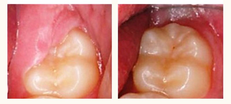 Капюшон зуба мудрости: фото до и после