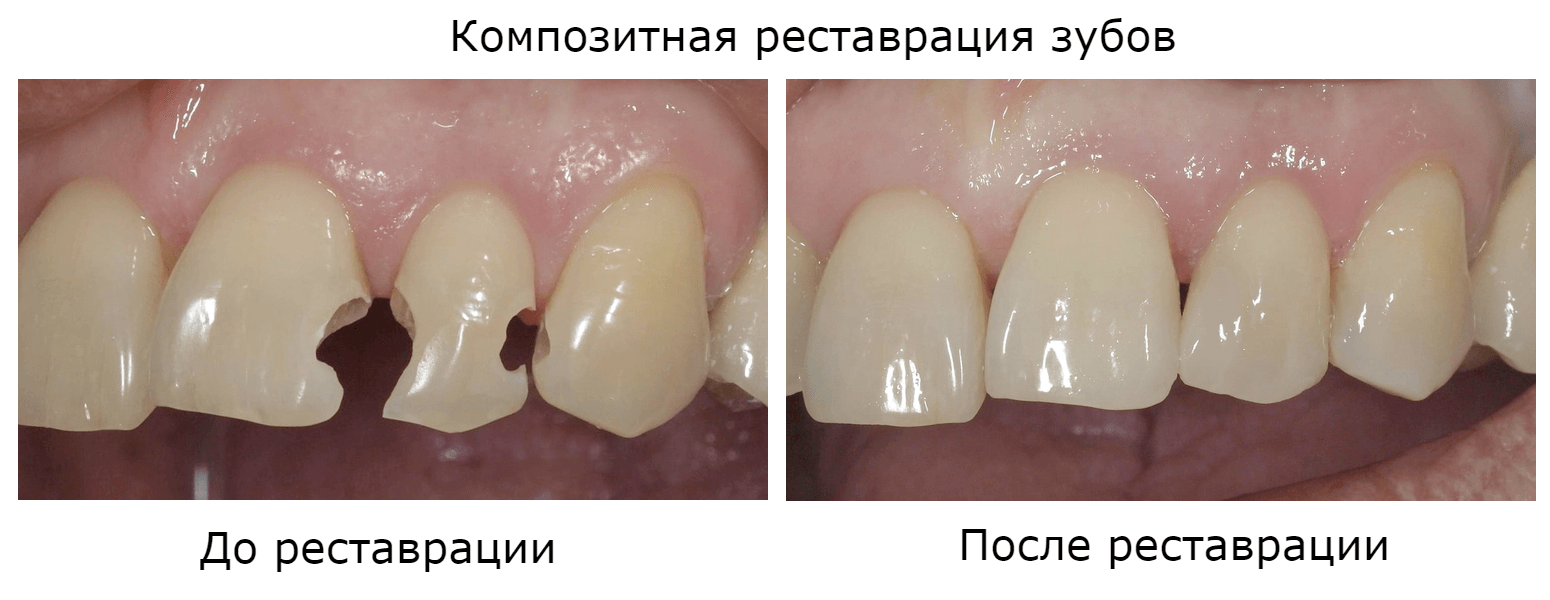 Композитная реставрация зубов до и после