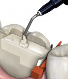 Нанокомпозиты в стоматологии