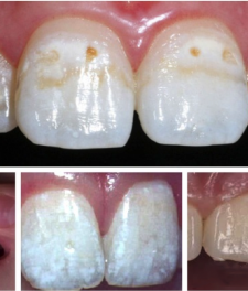 Серебрение молочных зубов у детей - фото до и после