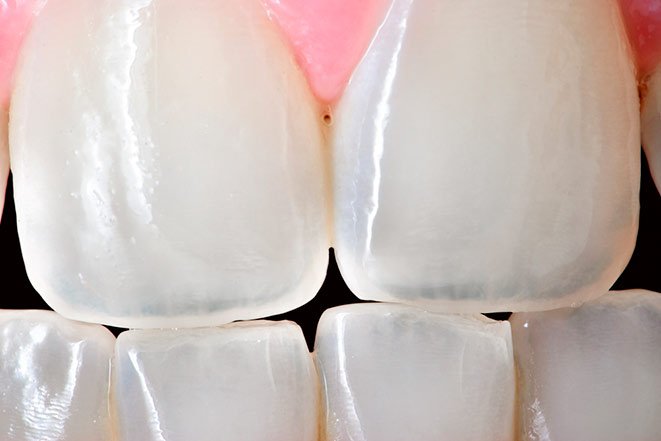 Прозрачные зубы фото