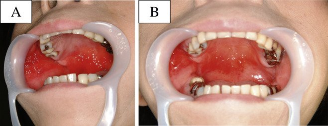 Аллергия на зубные протезы - фото