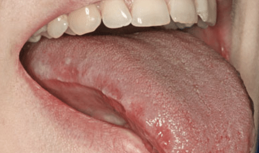 Отпечатки зубов на языке