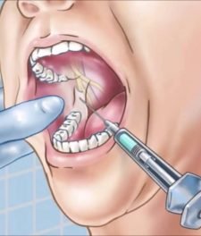 Мандибулярная анестезия в стоматологии
